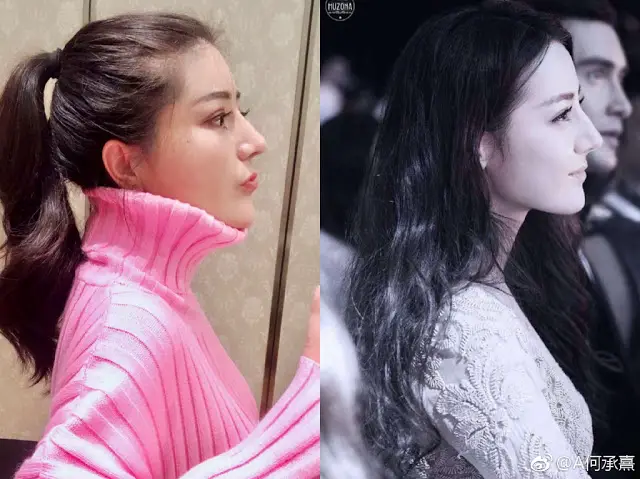 Dilraba Dilmurat Plastic Surgery Before